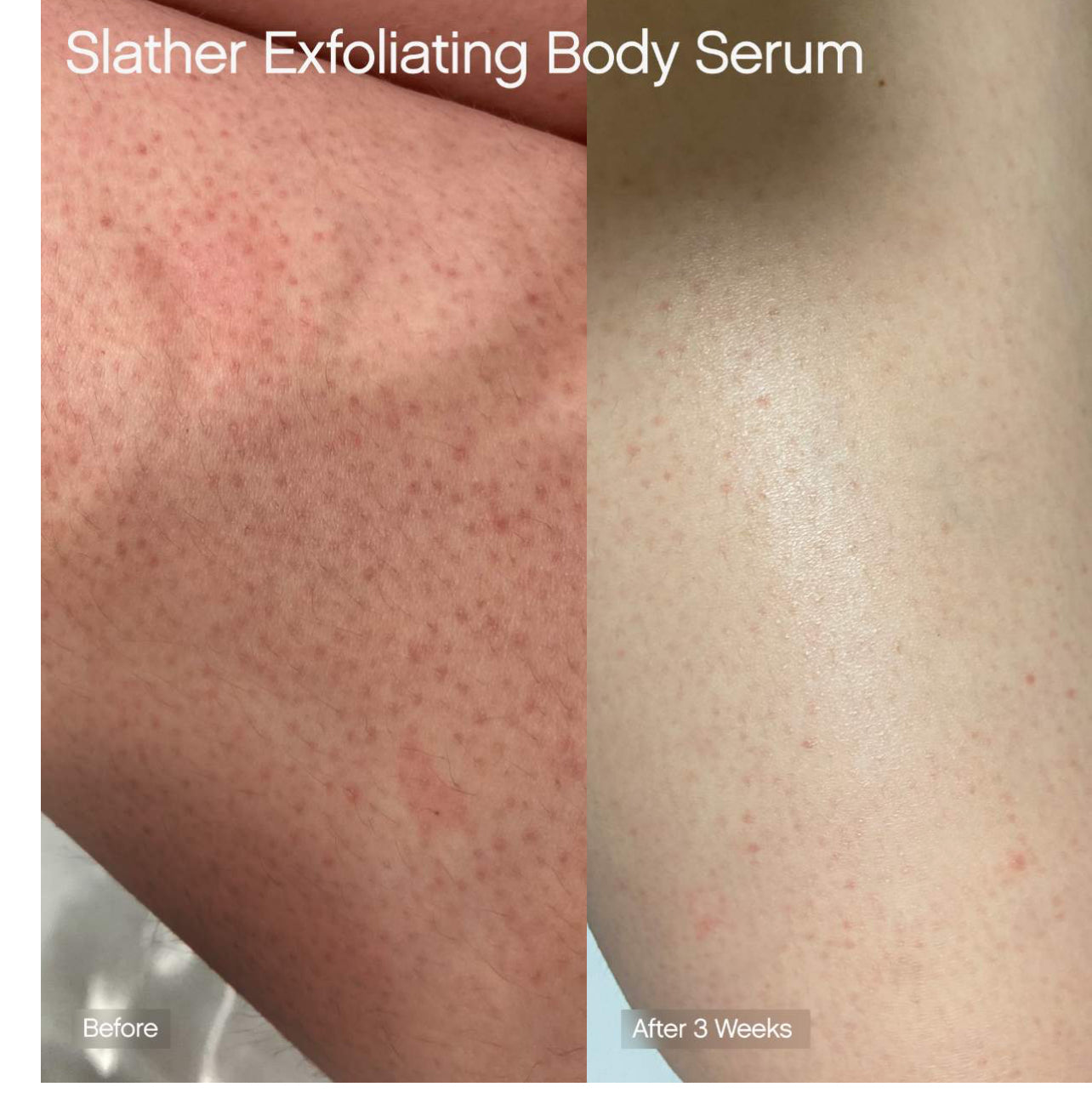 Topicals -Slather Exfoliating Body Serum with Retinol and AHAs